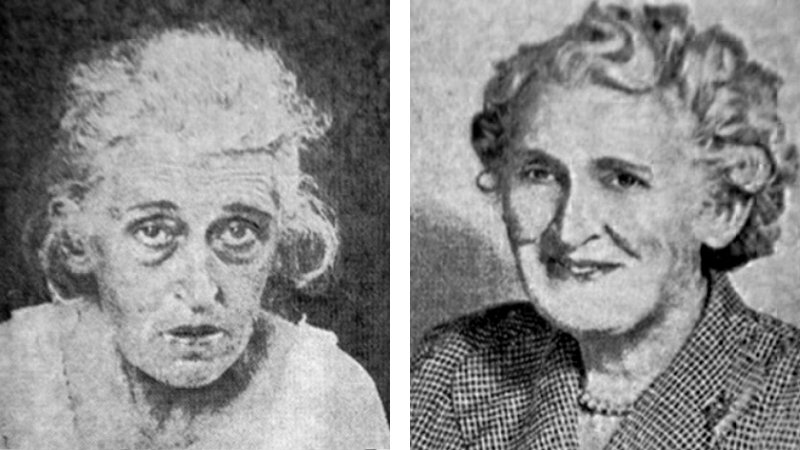Některým pacientům lobotomie údajně pomohla. Vlevo je snímek ženy před zákrokem, vpravo stejná žena o nějaký čas později.